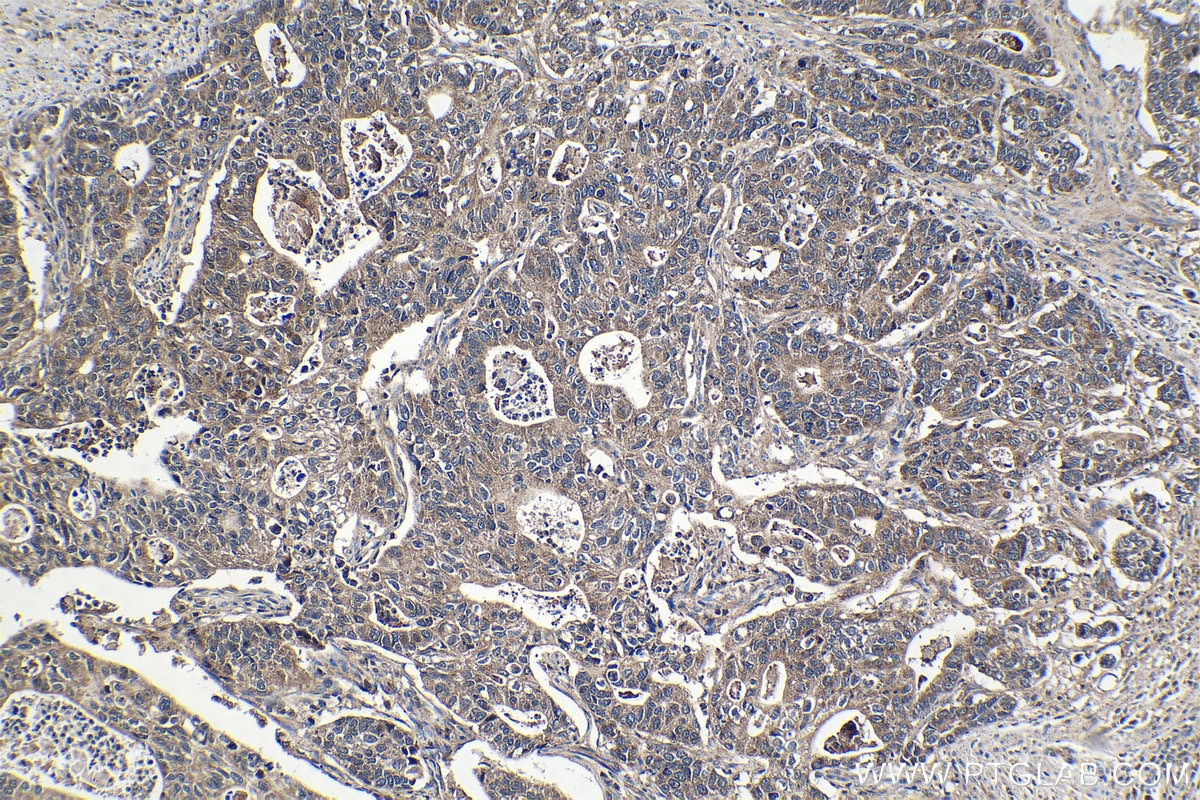 Immunohistochemical analysis of paraffin-embedded human stomach cancer tissue slide using KHC1379 (GLI2 IHC Kit).