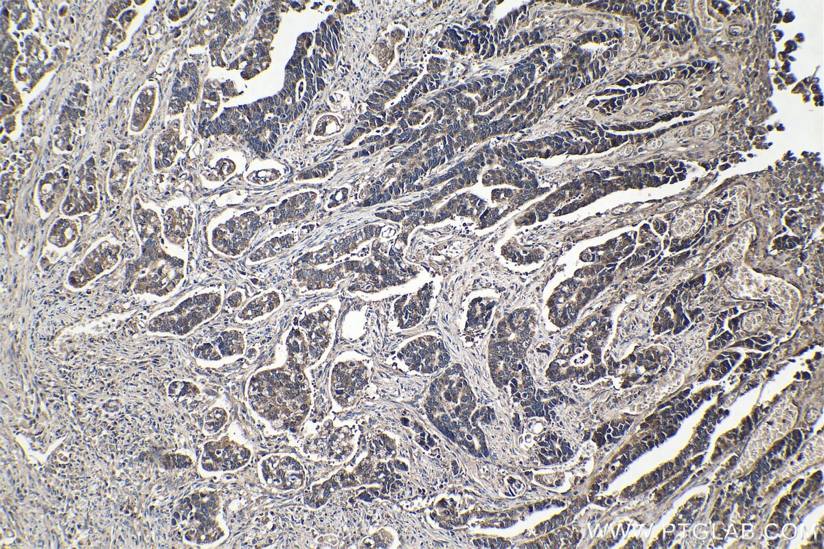 Immunohistochemical analysis of paraffin-embedded human stomach cancer tissue slide using KHC1379 (GLI2 IHC Kit).