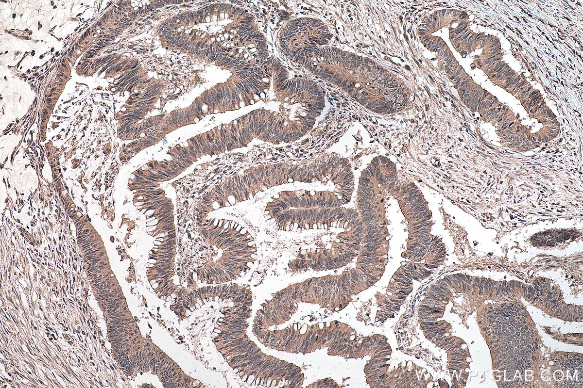 Immunohistochemical analysis of paraffin-embedded human colon cancer tissue slide using KHC0137 (GLI3 IHC Kit).