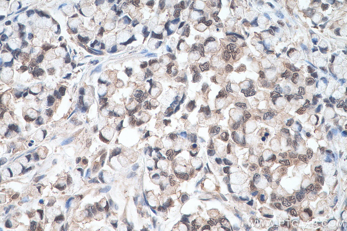 Immunohistochemical analysis of paraffin-embedded human colon cancer tissue slide using KHC0694 (GLO1 IHC Kit).