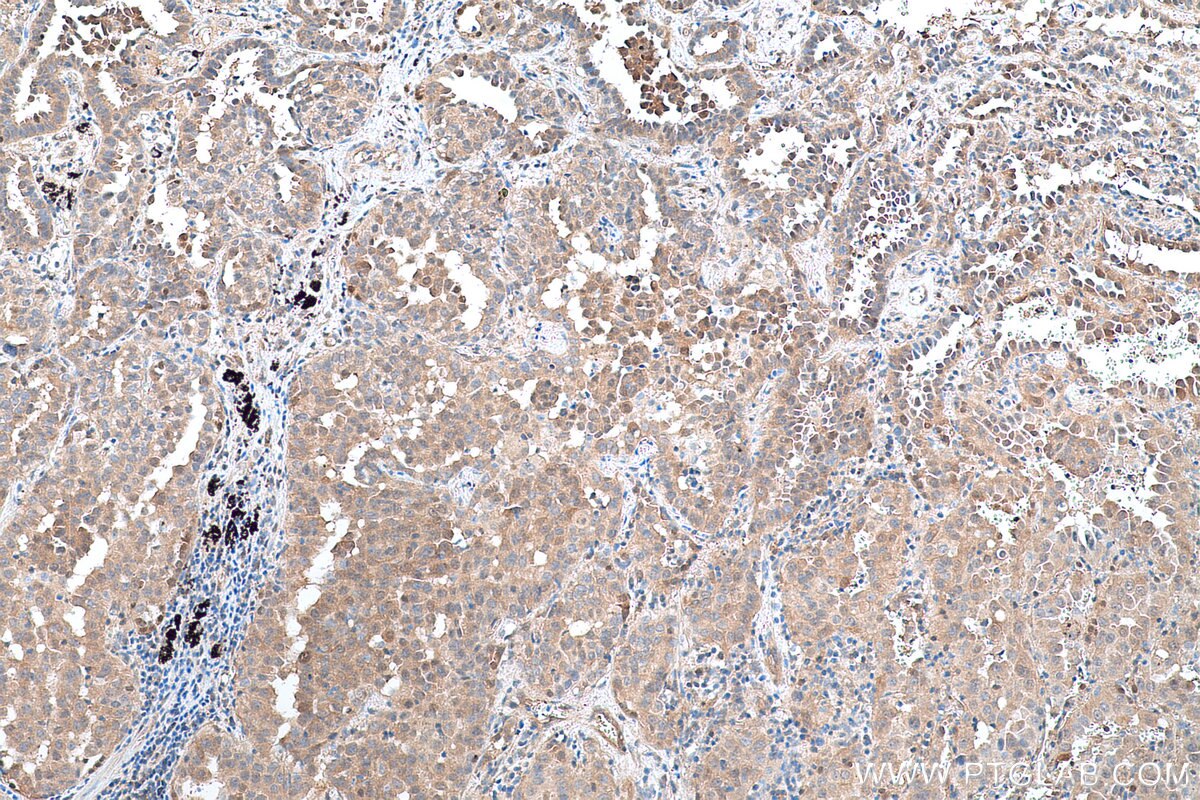 Immunohistochemical analysis of paraffin-embedded human lung cancer tissue slide using KHC0694 (GLO1 IHC Kit).