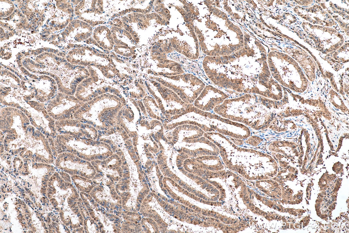 Immunohistochemical analysis of paraffin-embedded human ovary tumor tissue slide using KHC0694 (GLO1 IHC Kit).
