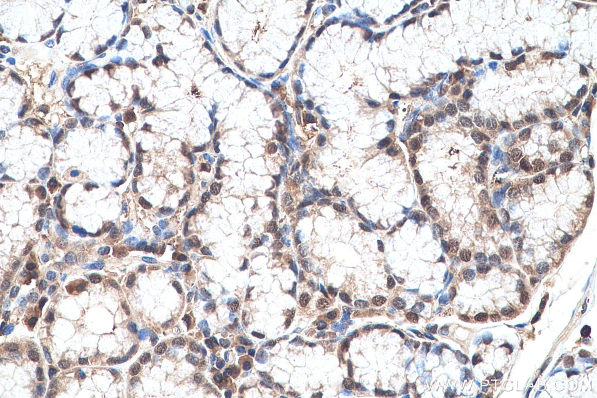 Immunohistochemical analysis of paraffin-embedded human stomach cancer tissue slide using KHC0694 (GLO1 IHC Kit).