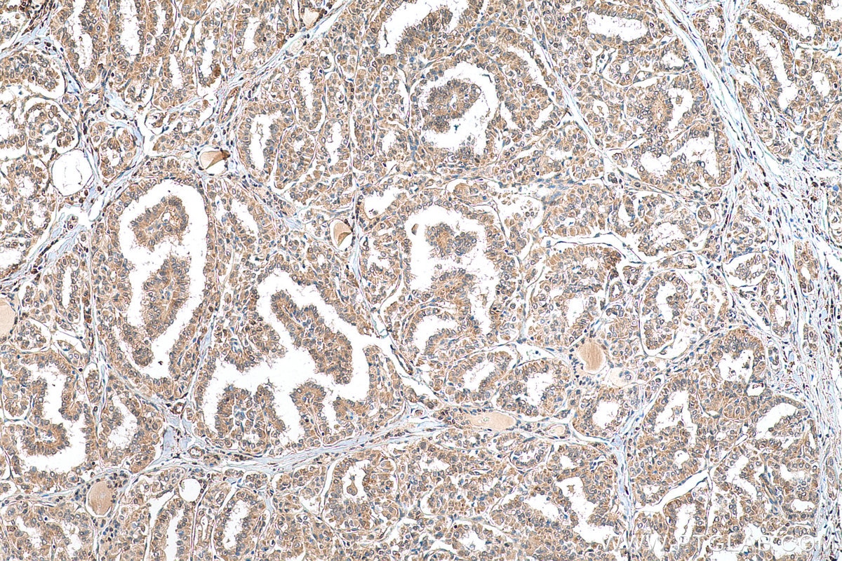 Immunohistochemical analysis of paraffin-embedded human thyroid cancer tissue slide using KHC0694 (GLO1 IHC Kit).
