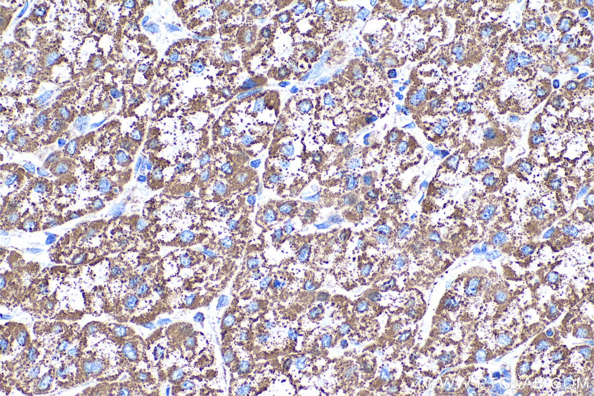 Immunohistochemical analysis of paraffin-embedded human liver cancer tissue slide using KHC0518 (GLUD1 IHC Kit).