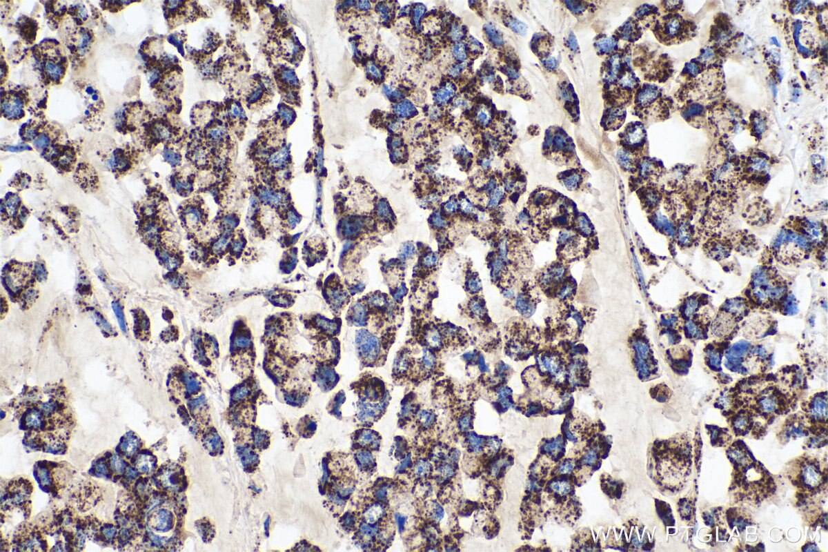 Immunohistochemical analysis of paraffin-embedded human colon cancer tissue slide using KHC0518 (GLUD1 IHC Kit).