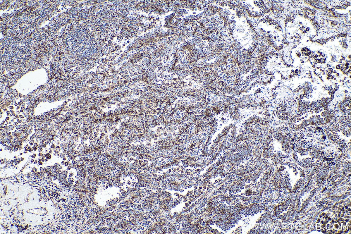 Immunohistochemical analysis of paraffin-embedded human lung cancer tissue slide using KHC0518 (GLUD1 IHC Kit).