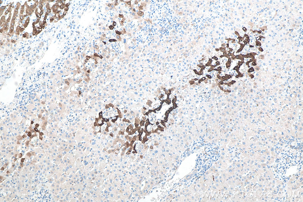 Immunohistochemical analysis of paraffin-embedded human liver cancer tissue slide using KHC0037 (GLUL IHC Kit).