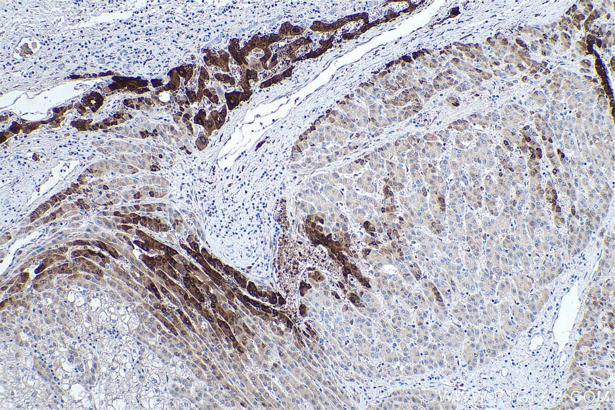 Immunohistochemical analysis of paraffin-embedded human liver cancer tissue slide using KHC0037 (GLUL IHC Kit).