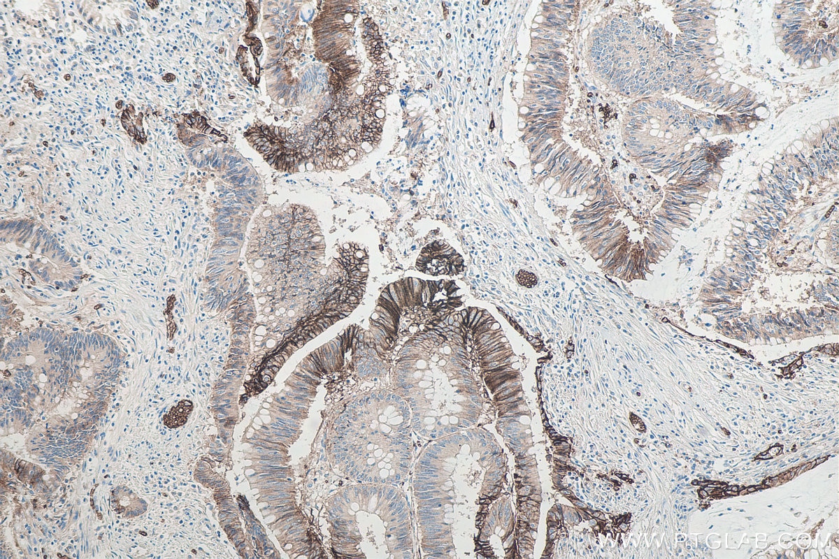 Immunohistochemical analysis of paraffin-embedded human colon cancer tissue slide using KHC0036 (GLUT1 IHC Kit)