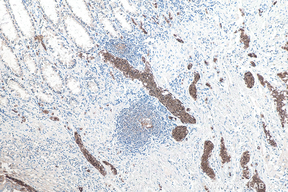 Immunohistochemical analysis of paraffin-embedded human colon cancer tissue slide using KHC0036 (GLUT1 IHC Kit). This view was captured from cancer adjacent region. Note that red blood cells are well stained. 