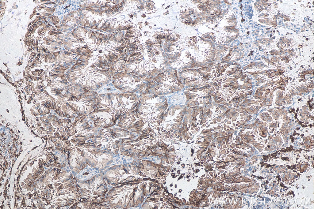 Immunohistochemical analysis of paraffin-embedded human lung cancer tissue slide using KHC0036 (GLUT1 IHC Kit)