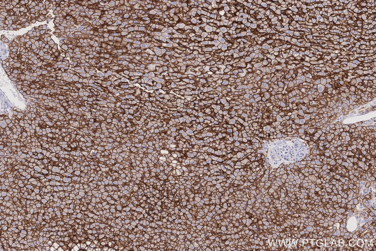 Immunohistochemical analysis of paraffin-embedded human hepatocirrhosis tissue slide using KHC3177 (GLUT2 IHC Kit).