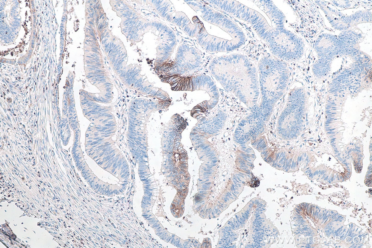 Immunohistochemical analysis of paraffin-embedded human colon cancer tissue slide using KHC0090 (GLUT3 IHC Kit).