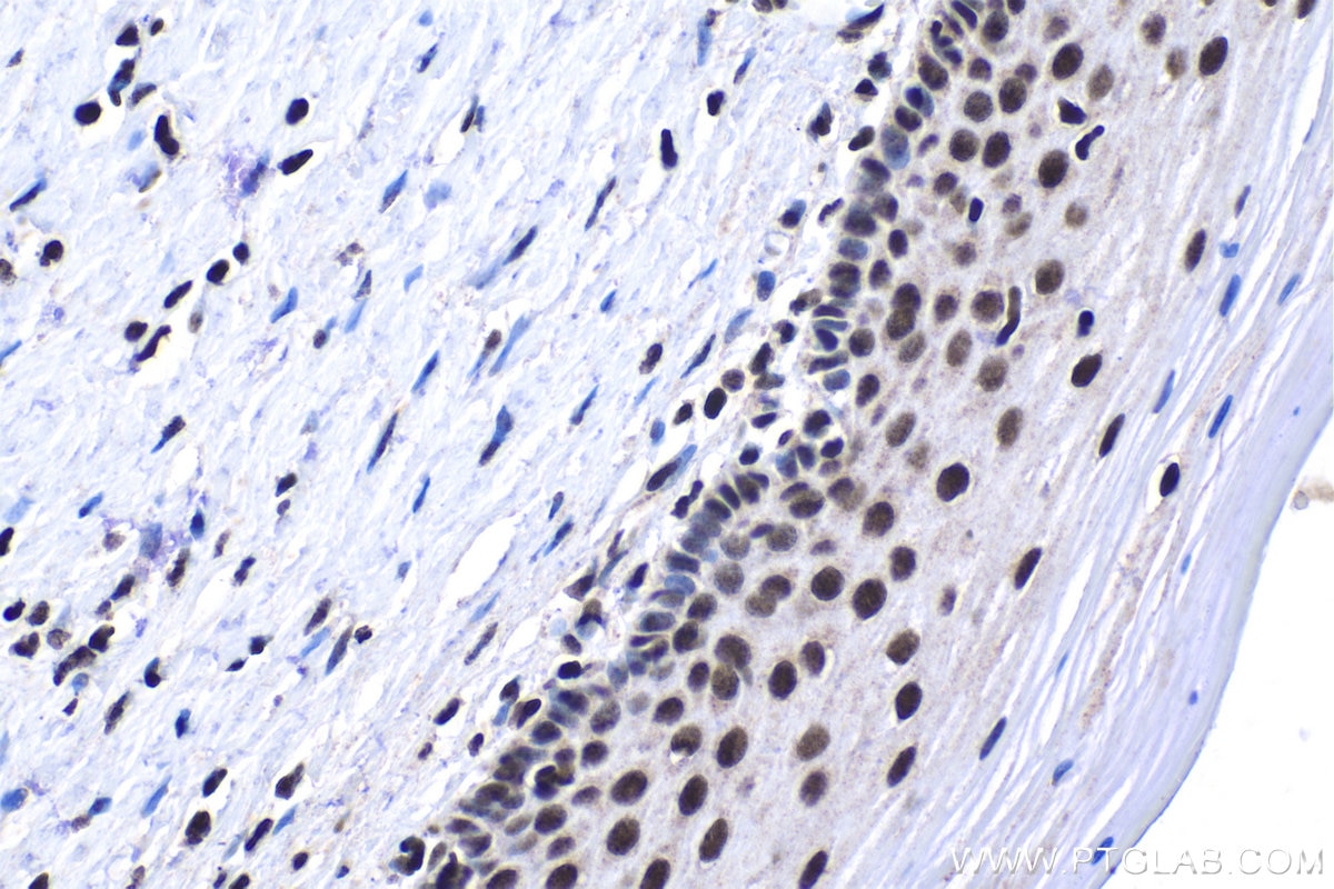 Immunohistochemical analysis of paraffin-embedded human cervical cancer tissue slide using KHC1783 (GLYR1 IHC Kit).