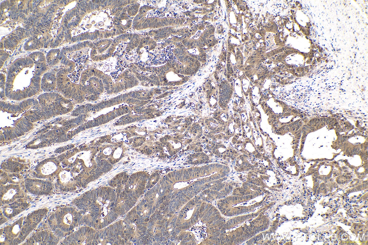 Immunohistochemical analysis of paraffin-embedded human colon cancer tissue slide using KHC0697 (GMDS IHC Kit).