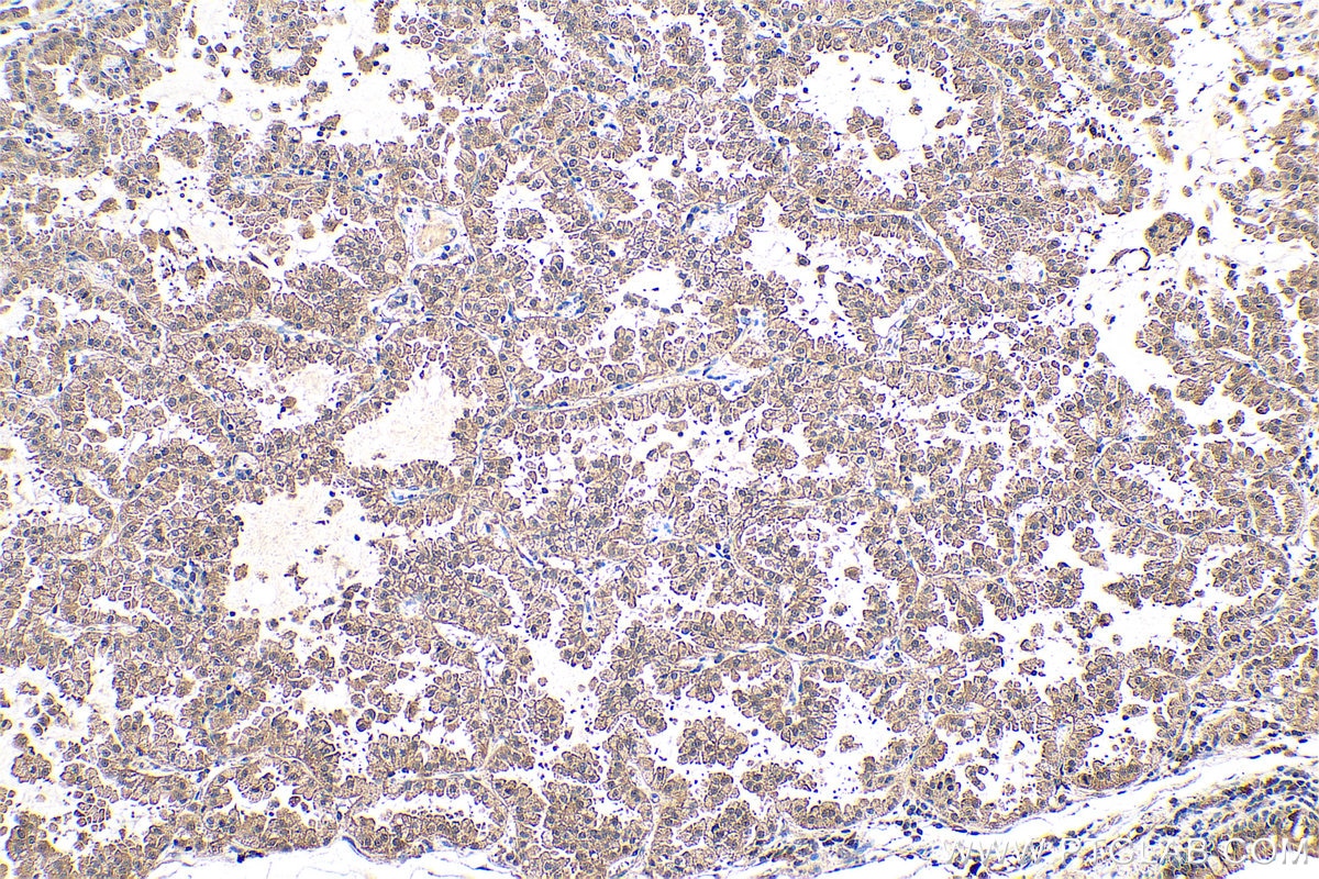 Immunohistochemical analysis of paraffin-embedded human lung cancer tissue slide using KHC0697 (GMDS IHC Kit).