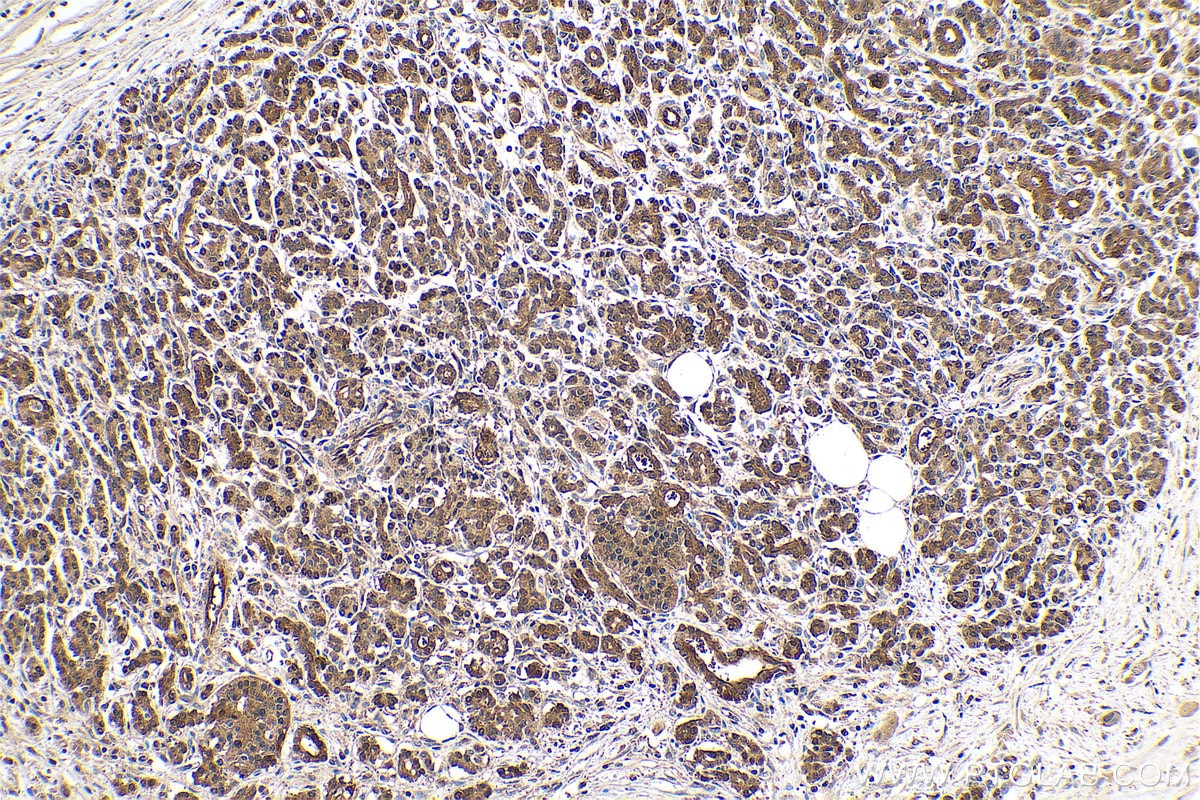 Immunohistochemical analysis of paraffin-embedded human pancreas cancer tissue slide using KHC0697 (GMDS IHC Kit).