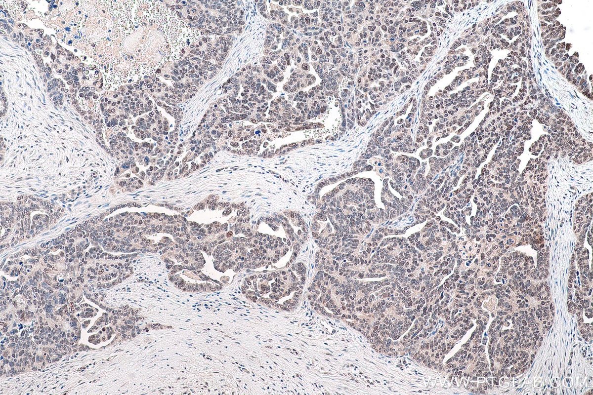 Immunohistochemical analysis of paraffin-embedded human ovary tumor tissue slide using KHC0890 (GMPS IHC Kit).