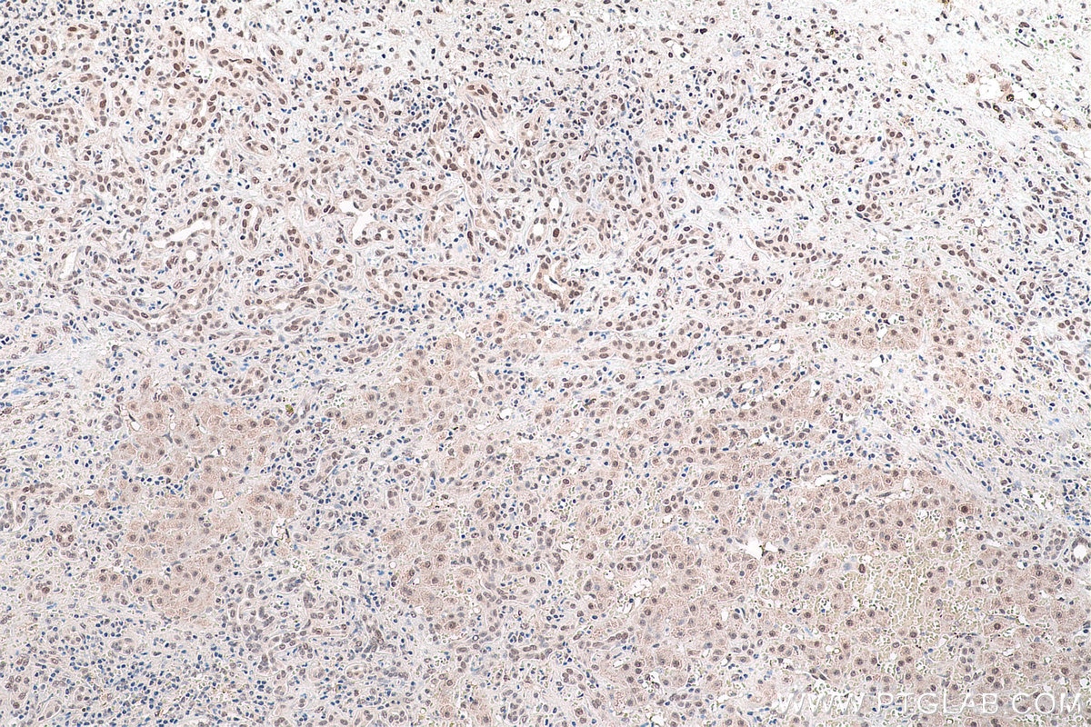 Immunohistochemical analysis of paraffin-embedded human liver cancer tissue slide using KHC0890 (GMPS IHC Kit).