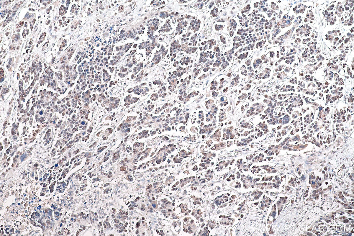 Immunohistochemical analysis of paraffin-embedded human colon cancer tissue slide using KHC0890 (GMPS IHC Kit).