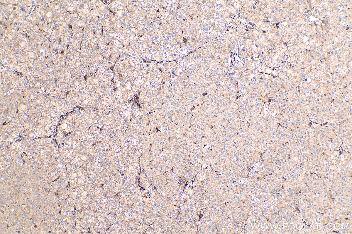 Immunohistochemical analysis of paraffin-embedded human liver cancer tissue slide using KHC0423 (GNAI1 IHC Kit).