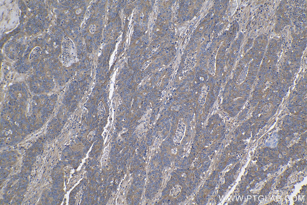 Immunohistochemical analysis of paraffin-embedded human colon cancer tissue slide using KHC1076 (GNAS IHC Kit).