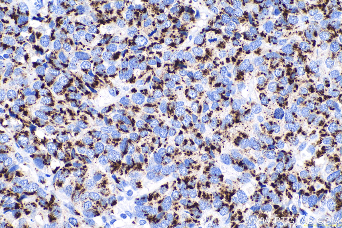 Immunohistochemical analysis of paraffin-embedded human stomach cancer tissue slide using KHC0719 (GOLM1 IHC Kit).