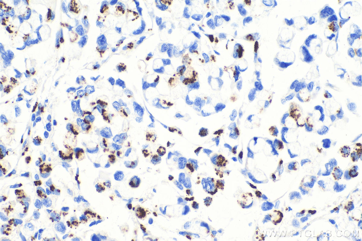 Immunohistochemical analysis of paraffin-embedded human colon cancer tissue slide using KHC0719 (GOLM1 IHC Kit).