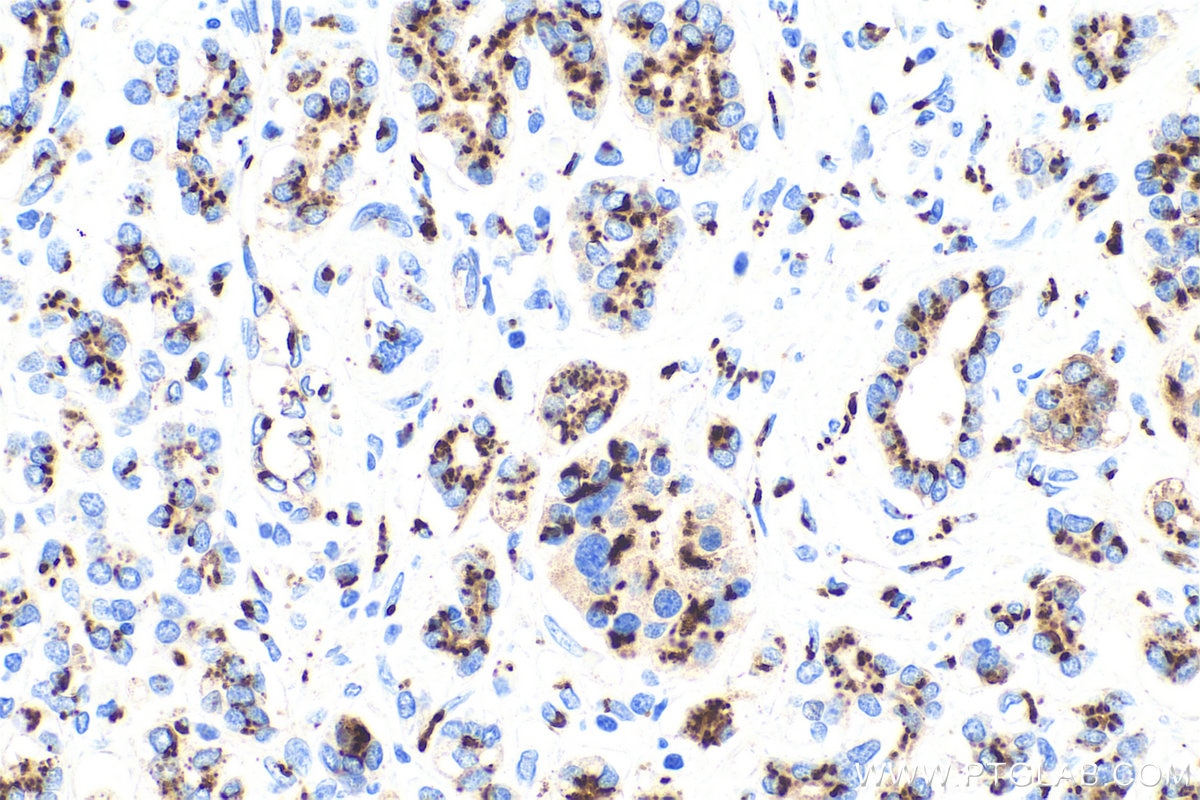 Immunohistochemical analysis of paraffin-embedded human pancreas cancer tissue slide using KHC0719 (GOLM1 IHC Kit).