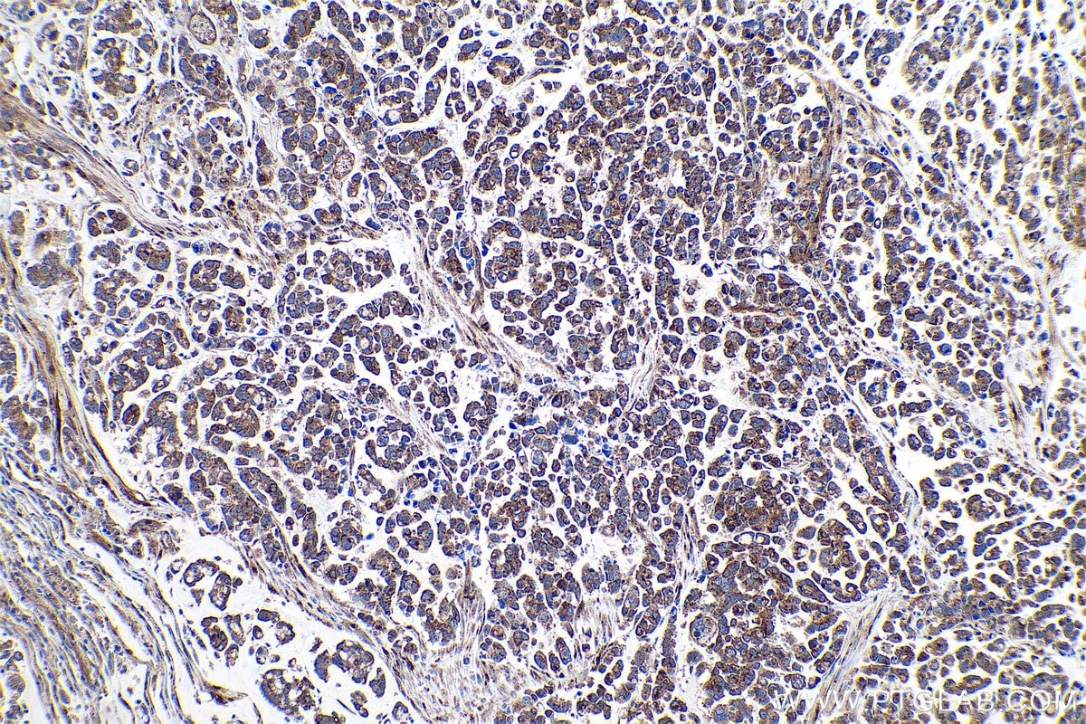 Immunohistochemical analysis of paraffin-embedded human colon cancer tissue slide using KHC0947 (GORASP2 IHC Kit).
