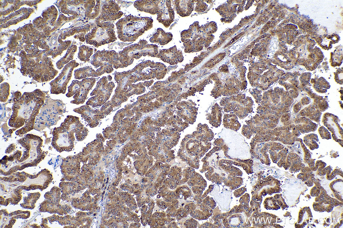 Immunohistochemical analysis of paraffin-embedded human thyroid cancer tissue slide using KHC0947 (GORASP2 IHC Kit).