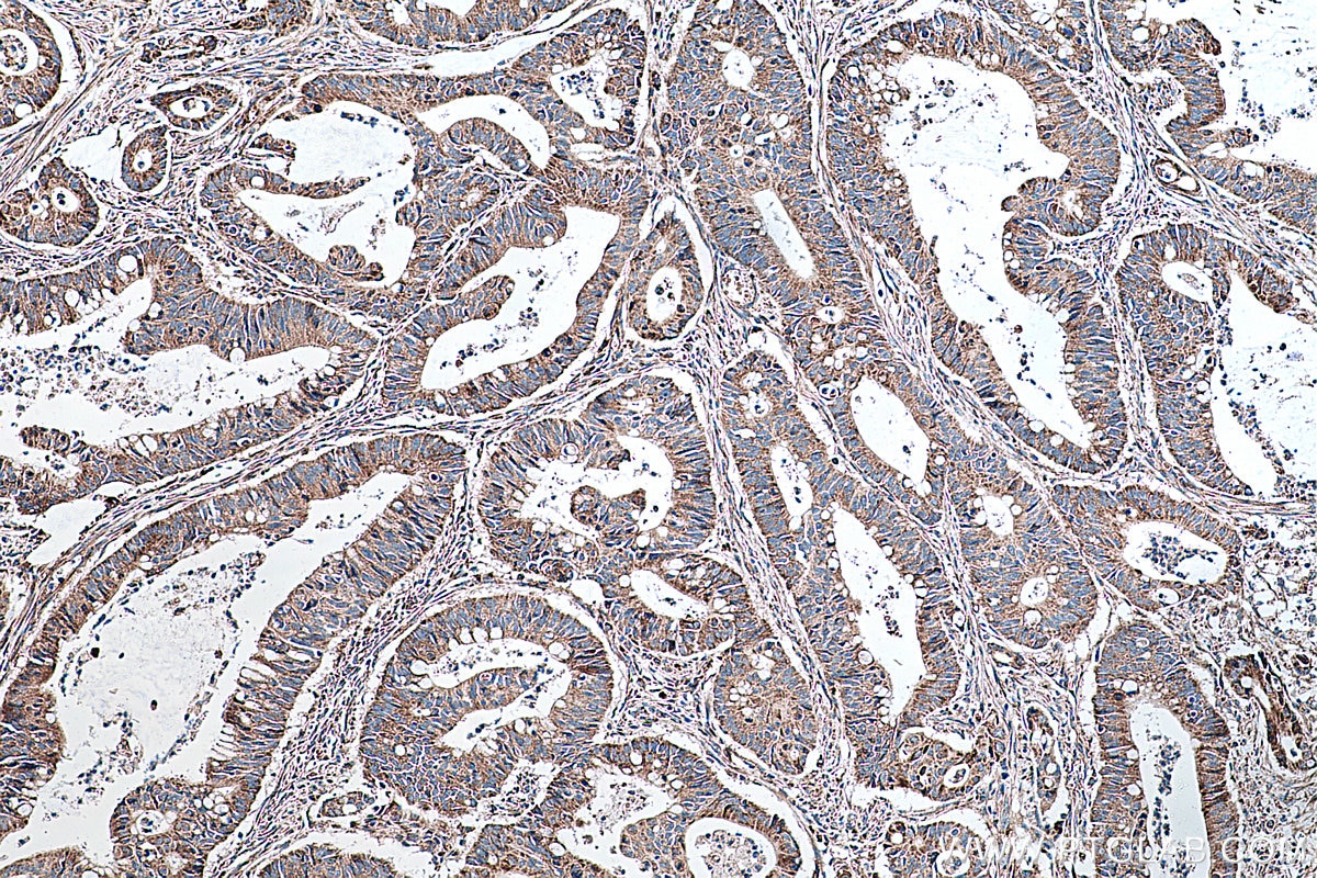 Immunohistochemical analysis of paraffin-embedded human colon cancer tissue slide using KHC0236 (GPD2 IHC Kit).
