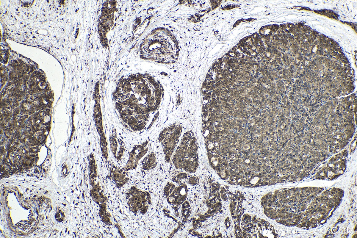 Immunohistochemical analysis of paraffin-embedded human thyroid cancer tissue slide using KHC1706 (GPS2 IHC Kit).
