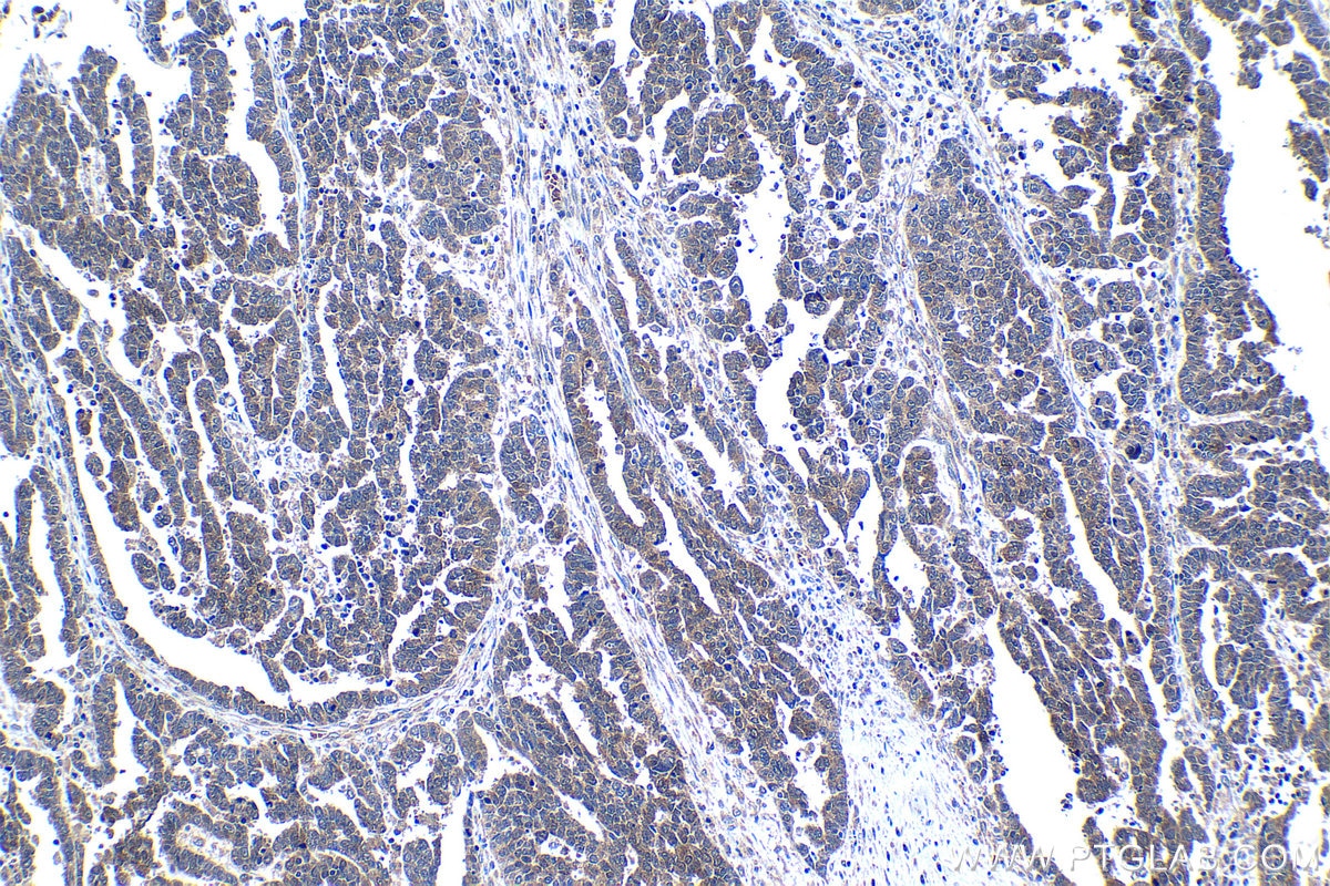 Immunohistochemical analysis of paraffin-embedded human ovary tumor tissue slide using KHC1285 (GRB7 IHC Kit).