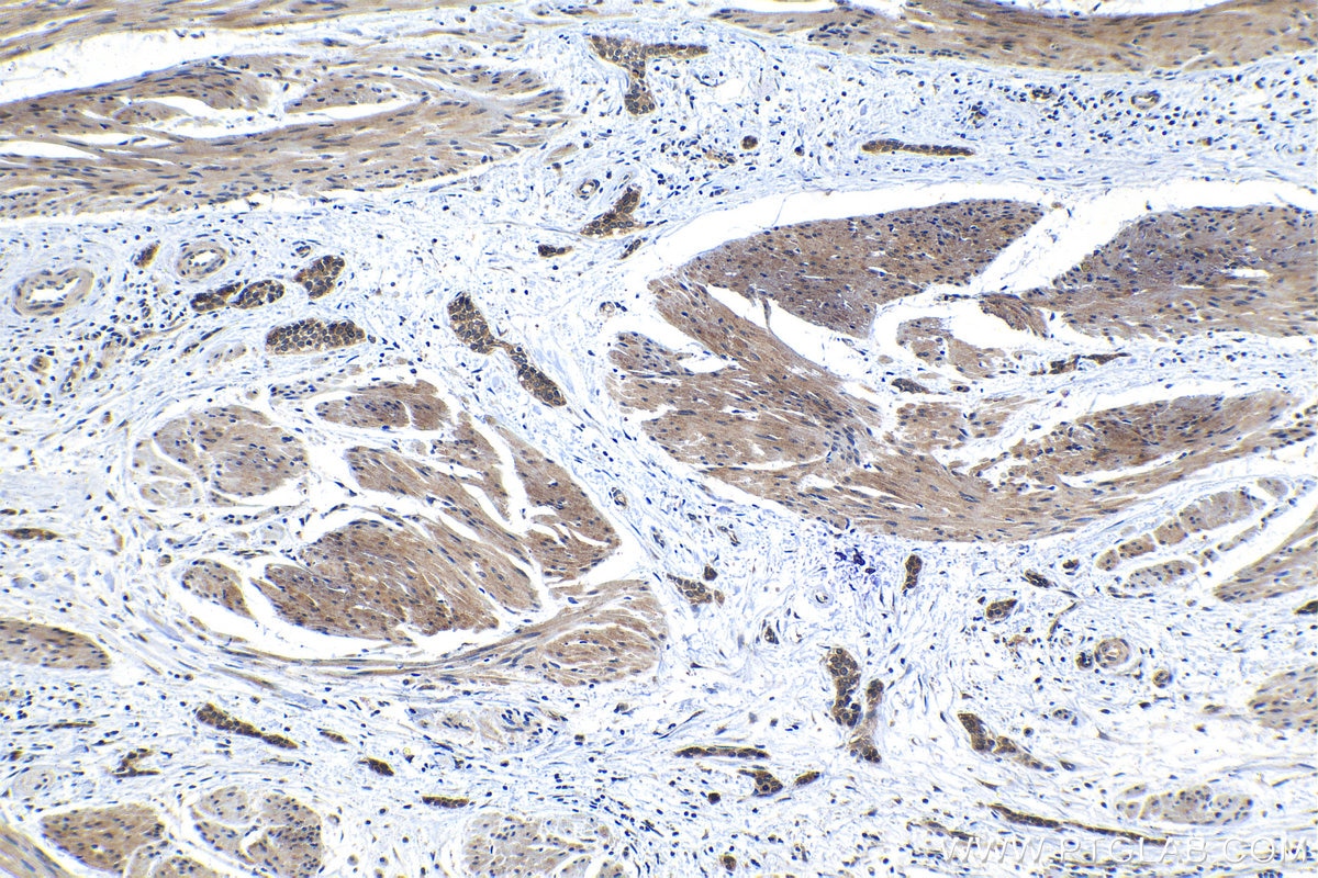 Immunohistochemical analysis of paraffin-embedded human urothelial carcinoma tissue slide using KHC1285 (GRB7 IHC Kit).