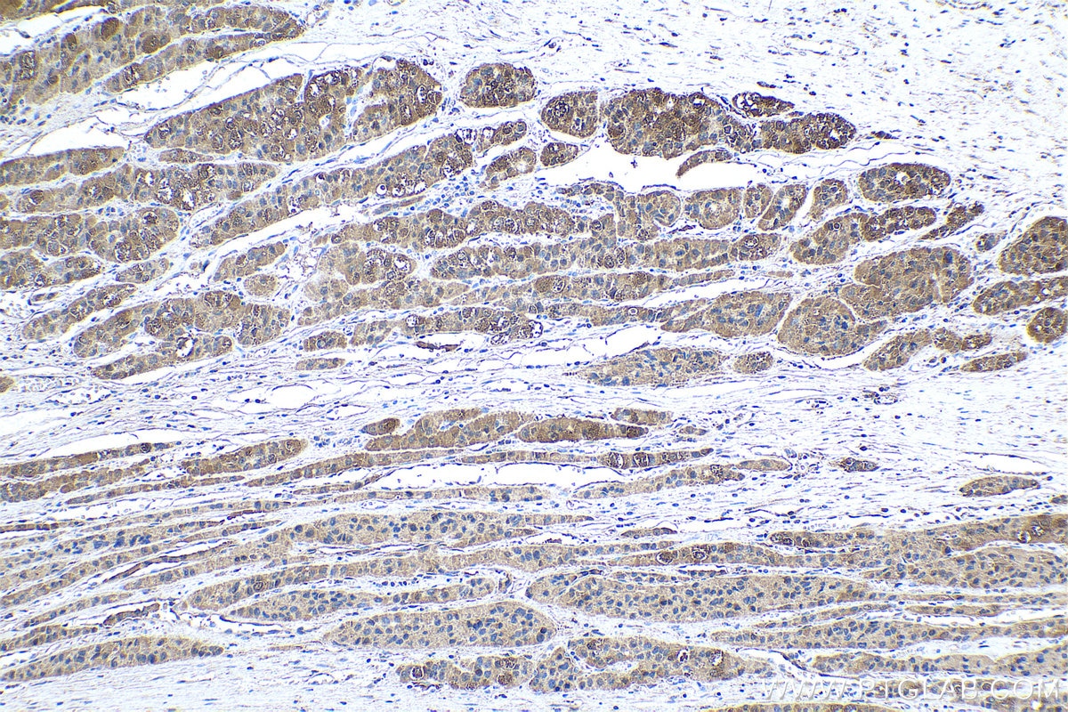 Immunohistochemical analysis of paraffin-embedded human liver cancer tissue slide using KHC0520 (GRHPR IHC Kit).