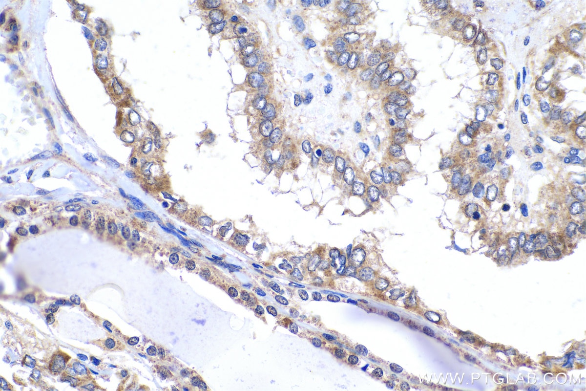 Immunohistochemical analysis of paraffin-embedded human thyroid cancer tissue slide using KHC0520 (GRHPR IHC Kit).