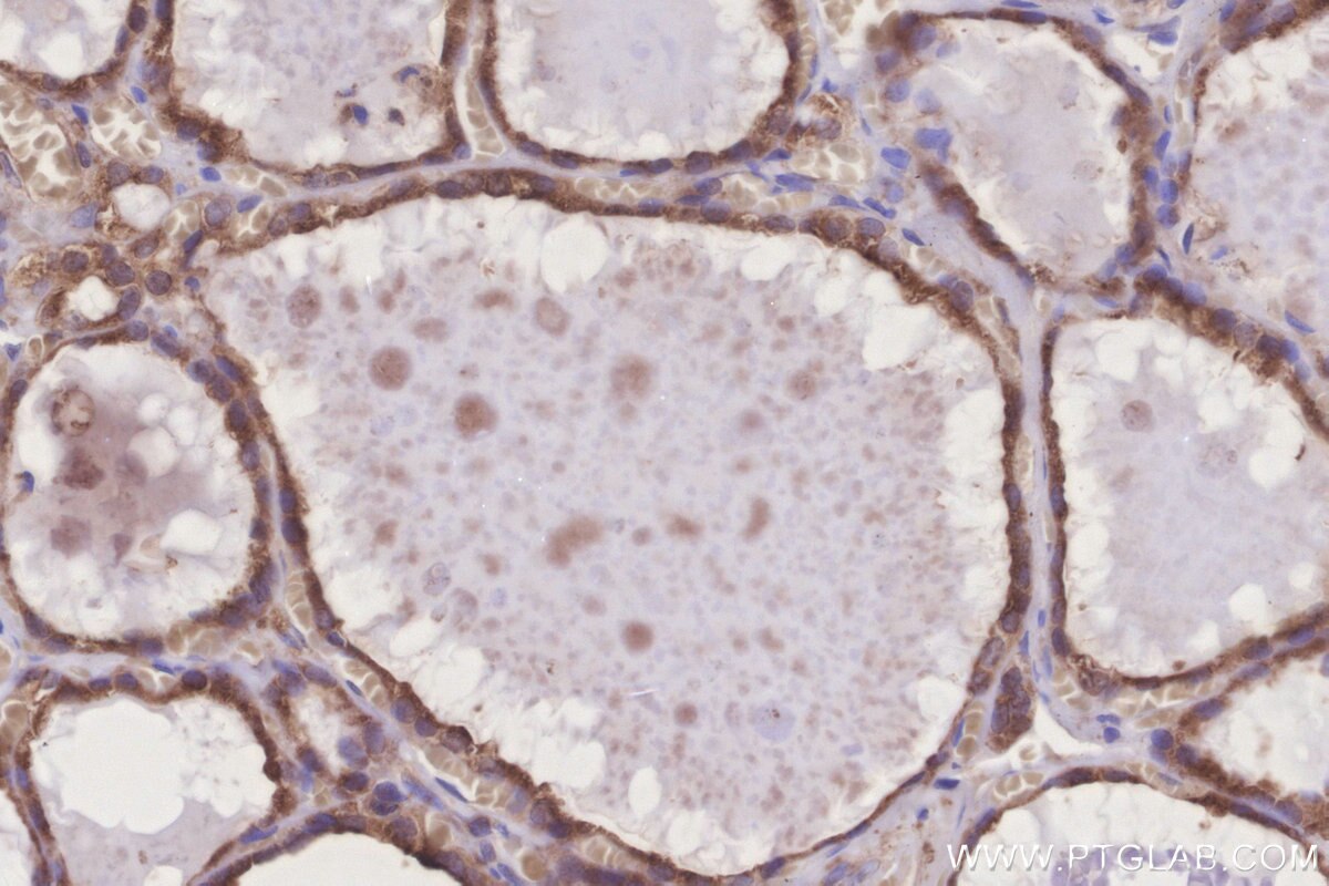 Immunohistochemical analysis of paraffin-embedded human thyroid cancer tissue slide using KHC3279 (GRINA IHC Kit).