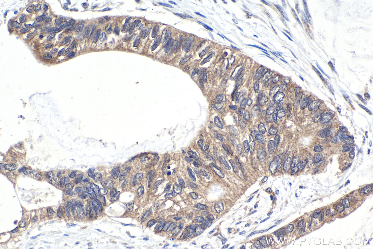 Immunohistochemical analysis of paraffin-embedded human urothelial carcinoma tissue slide using KHC1581 (GRK5 IHC Kit).