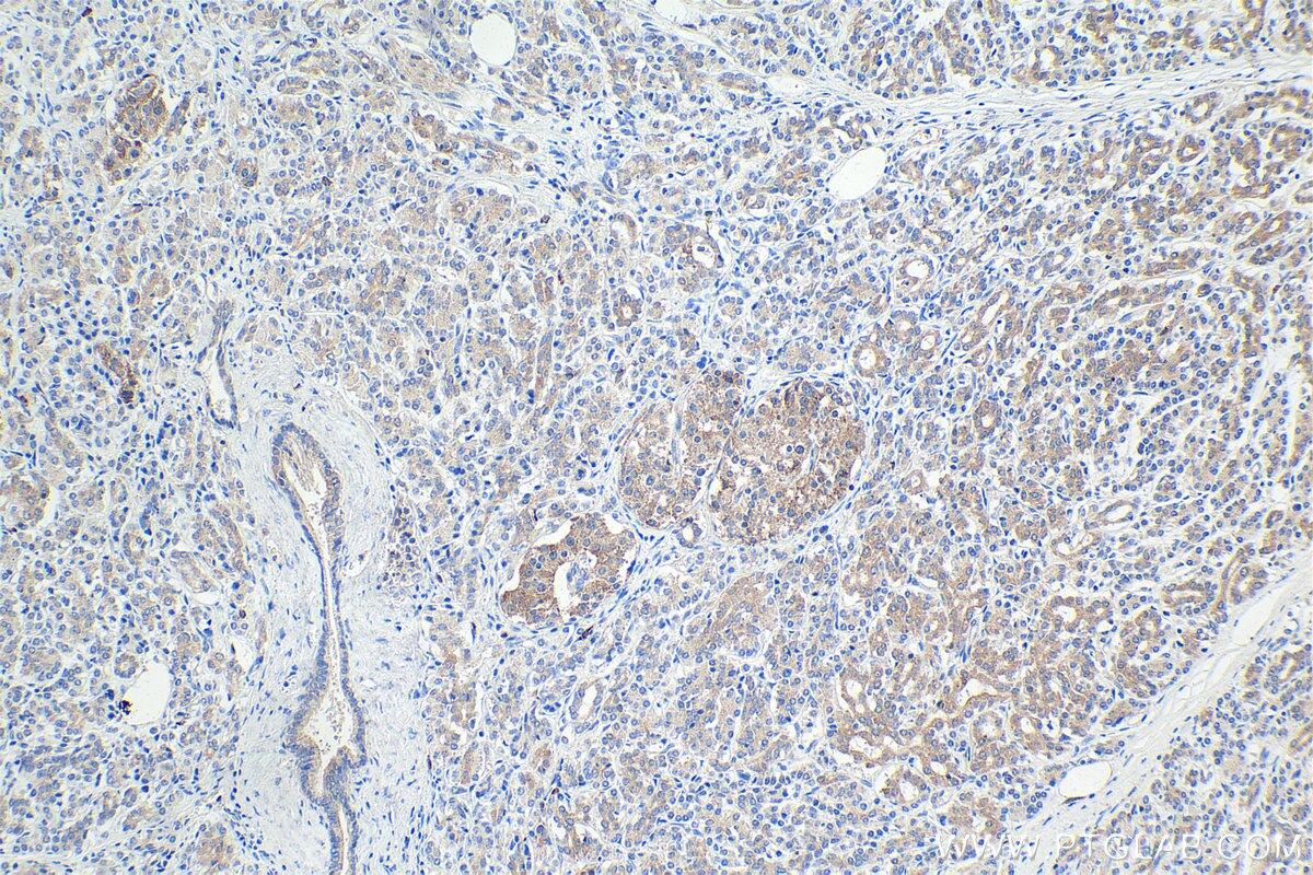 Immunohistochemical analysis of paraffin-embedded human pancreas cancer tissue slide using KHC1581 (GRK5 IHC Kit).