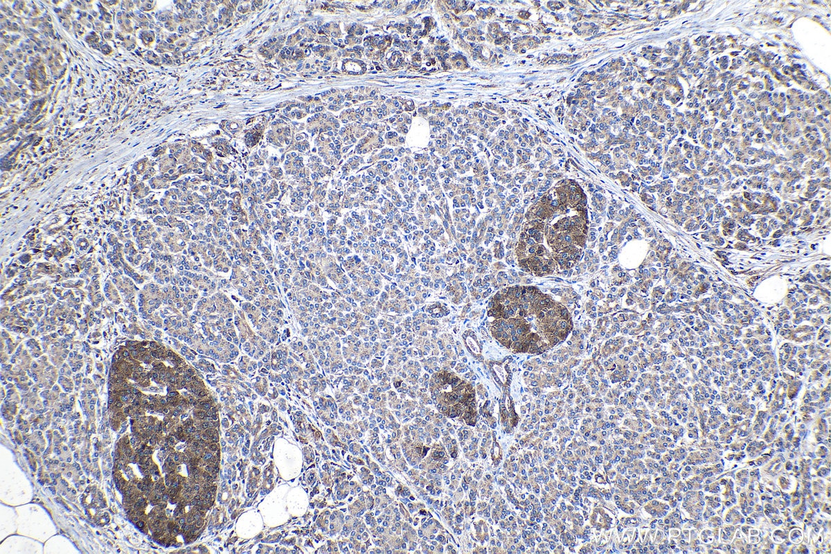 Immunohistochemical analysis of paraffin-embedded human pancreas cancer tissue slide using KHC1132 (GRN IHC Kit).