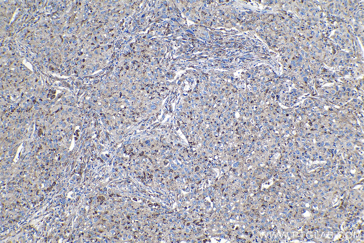 Immunohistochemical analysis of paraffin-embedded human lung cancer tissue slide using KHC1132 (GRN IHC Kit).