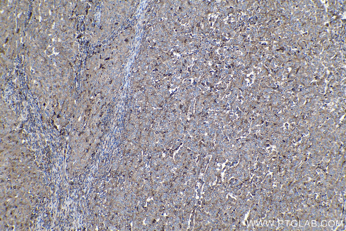 Immunohistochemical analysis of paraffin-embedded human ovary tumor tissue slide using KHC1132 (GRN IHC Kit).