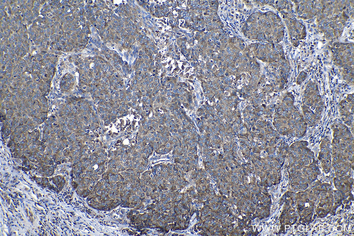 Immunohistochemical analysis of paraffin-embedded human stomach cancer tissue slide using KHC1132 (GRN IHC Kit).