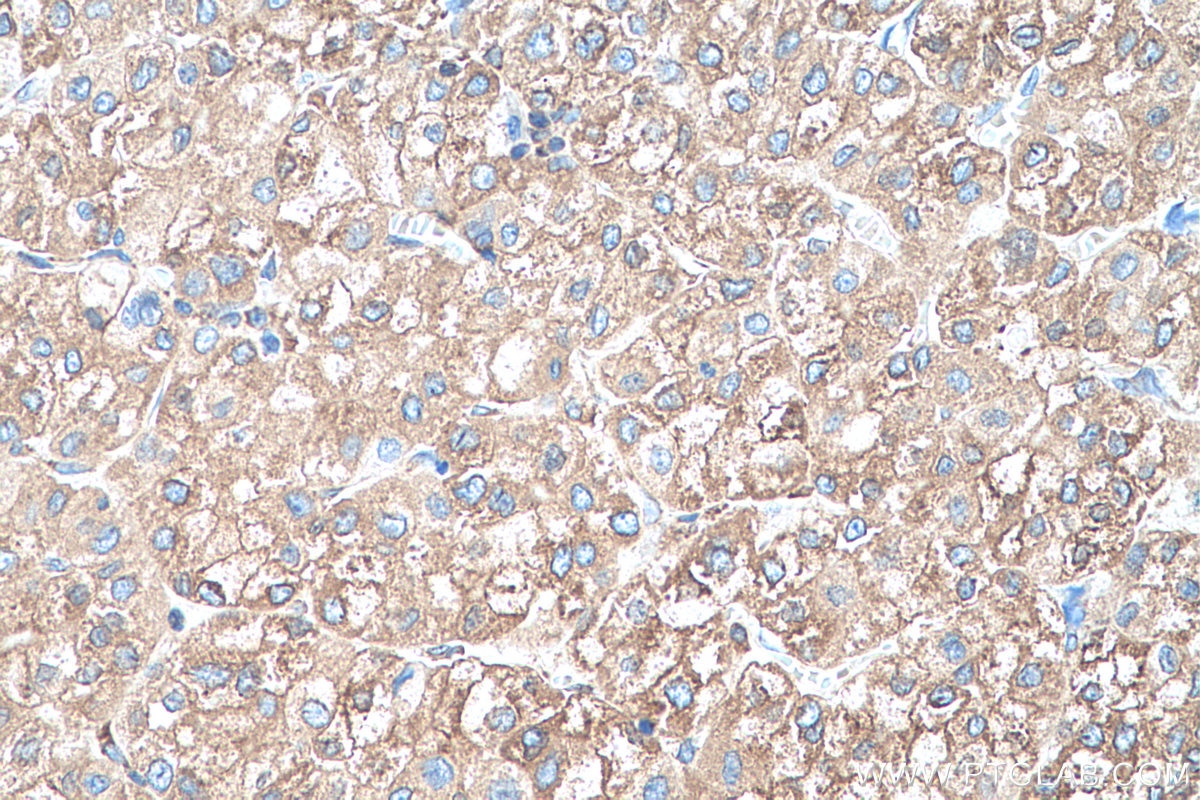 Immunohistochemical analysis of paraffin-embedded human liver cancer tissue slide using KHC0509 (GRP78/HSPA5 IHC Kit).