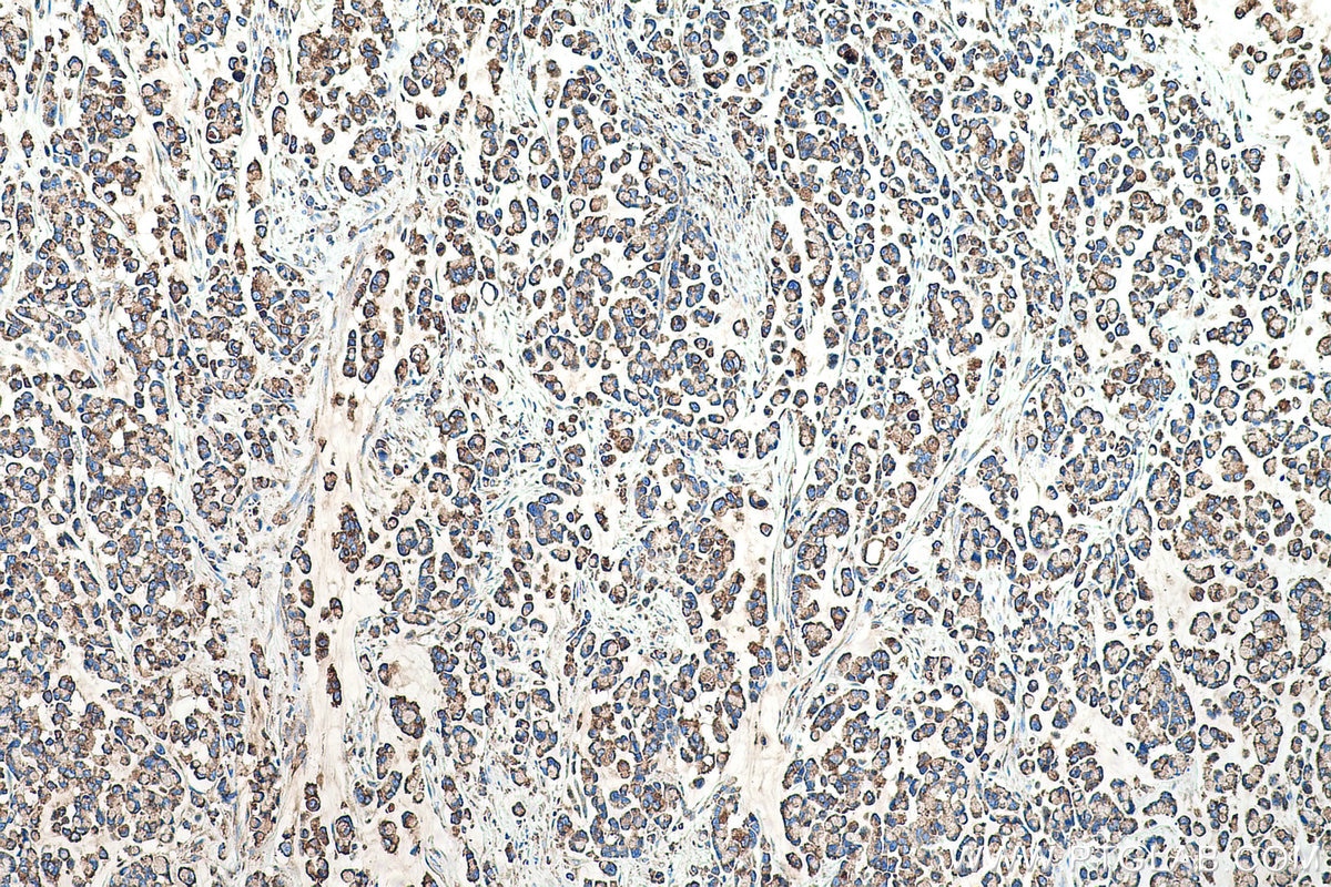 Immunohistochemical analysis of paraffin-embedded human colon cancer tissue slide using KHC0509 (GRP78/HSPA5 IHC Kit).