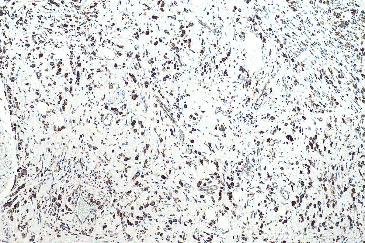 Immunohistochemical analysis of paraffin-embedded human stomach cancer tissue slide using KHC0509 (GRP78/HSPA5 IHC Kit).