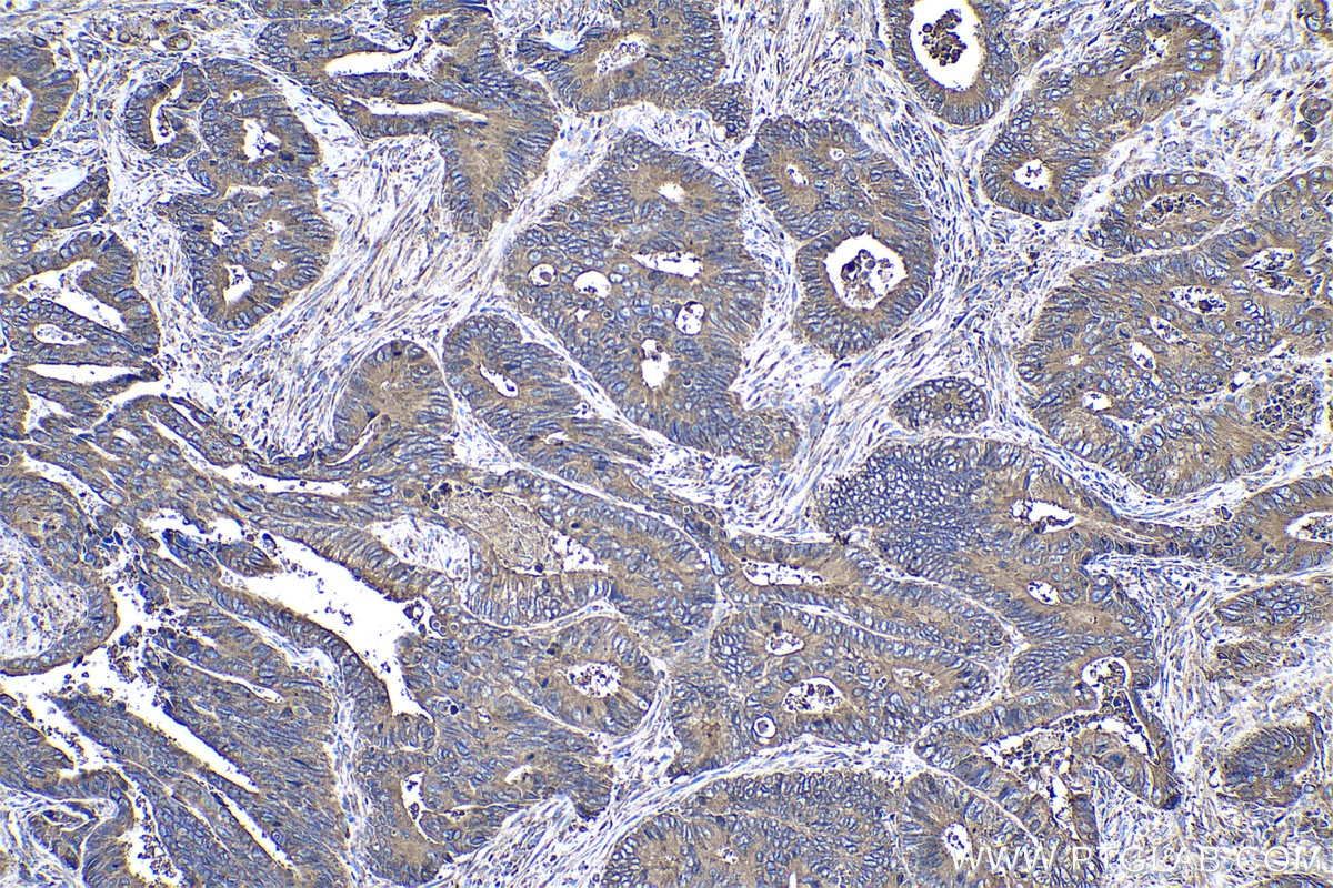 Immunohistochemical analysis of paraffin-embedded human colon cancer tissue slide using KHC0531 (GRP94/HSP90B1 IHC Kit).