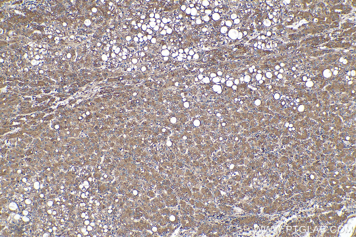 Immunohistochemical analysis of paraffin-embedded human liver cancer tissue slide using KHC0531 (GRP94/HSP90B1 IHC Kit).